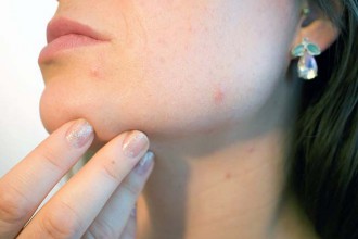 rimedi efficaci acne