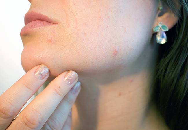 rimedi efficaci acne